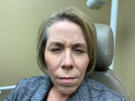 Botox® Cosmetic: Case 4 - After