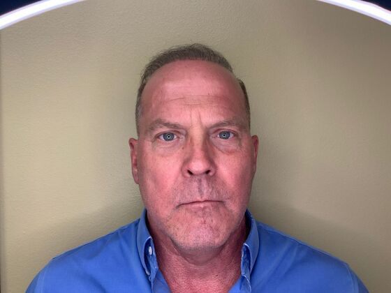 Botox® Cosmetic Case 5 - Before