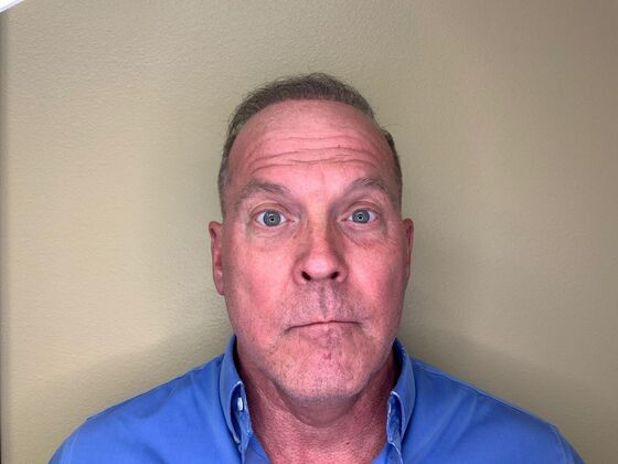 Botox® Cosmetic: Case 5 - Before