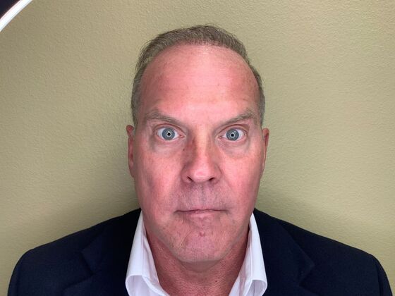 Botox® Cosmetic: Case 5 - After