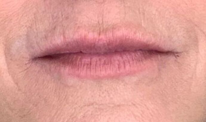 Filler Case 2 - Before