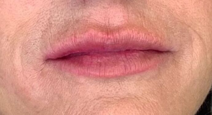 Filler Case 2 - After