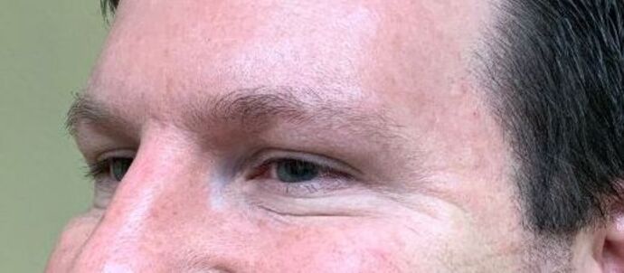 Botox® Cosmetic: Case 6 - After