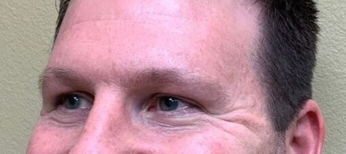 Botox® Cosmetic: Case 6 - Before