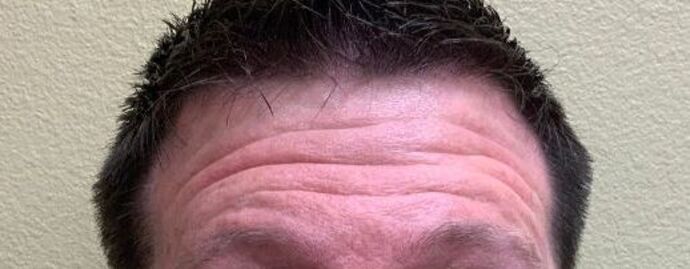 Botox® Cosmetic Case 6 - Before