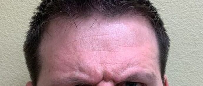 Botox® Cosmetic: Case 6 - Before