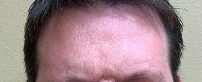 Botox® Cosmetic: Case 6 - After