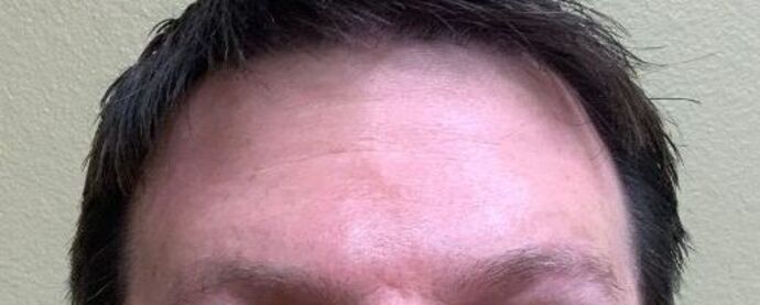 Botox® Cosmetic Case 6 - After