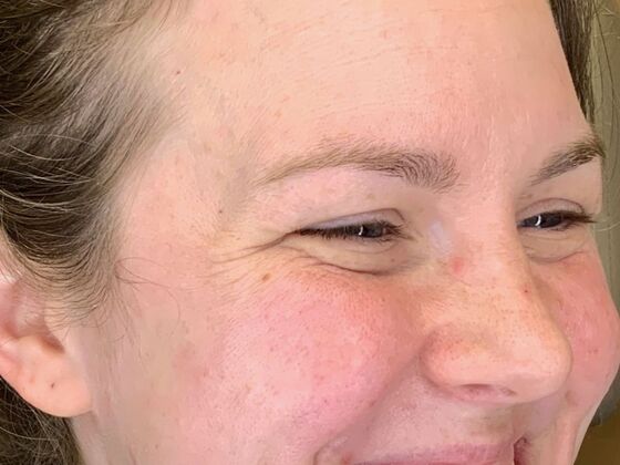 Botox® Cosmetic: Case 7 - Before