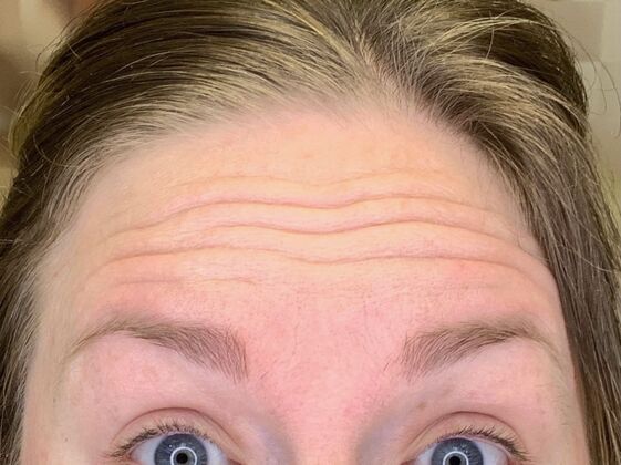 Botox® Cosmetic Case 7 - Before