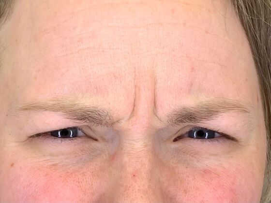 Botox® Cosmetic: Case 7 - Before