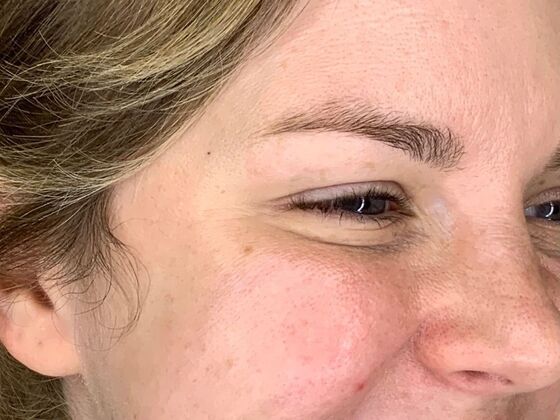 Botox® Cosmetic: Case 7 - After