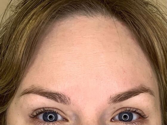 Botox® Cosmetic Case 7 - After