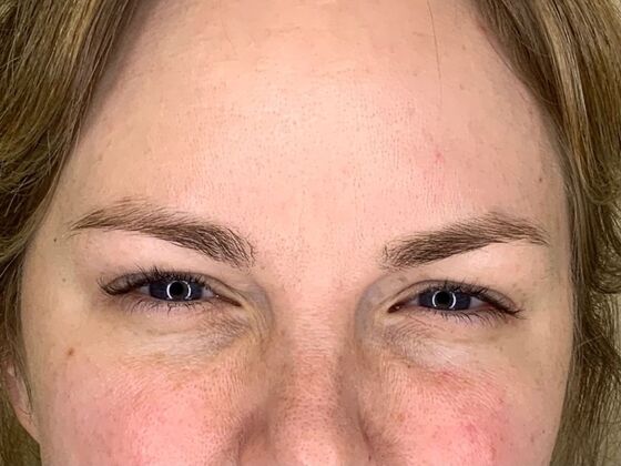 Botox® Cosmetic: Case 7 - After