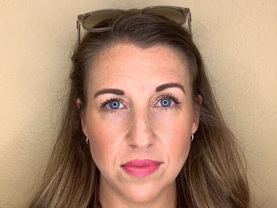 Botox® Cosmetic: Case 8 - Before