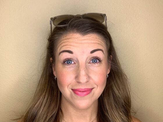 Botox® Cosmetic: Case 8 - Before