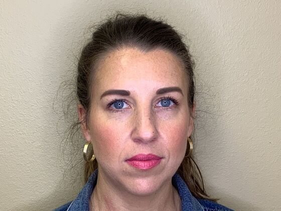 Botox® Cosmetic: Case 8 - After