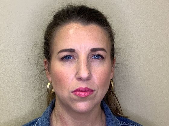 Botox® Cosmetic: Case 8 - After