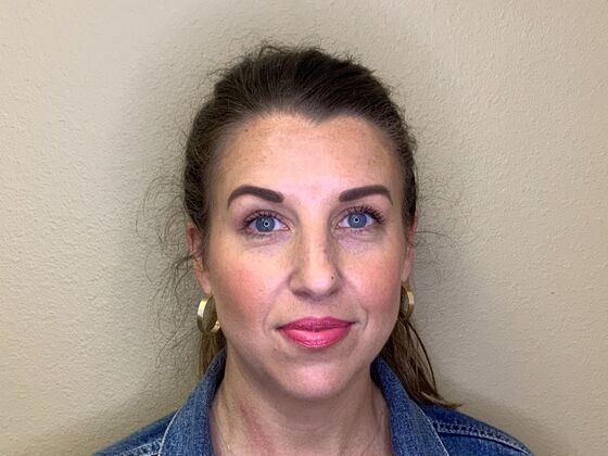 Botox® Cosmetic: Case 8 - After