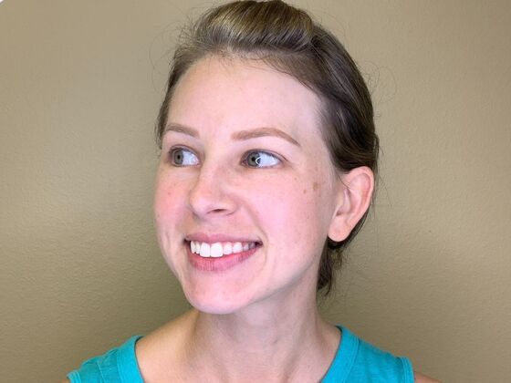 Botox® Cosmetic: Case 9 - Before