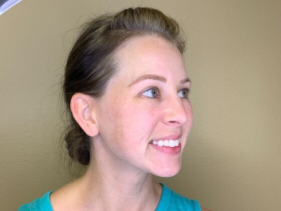 Botox® Cosmetic: Case 9 - Before