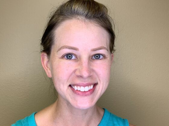 Botox® Cosmetic Case 9 - Before