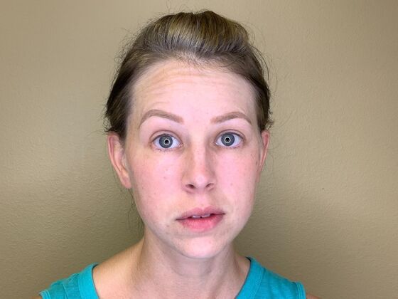 Botox® Cosmetic: Case 9 - Before