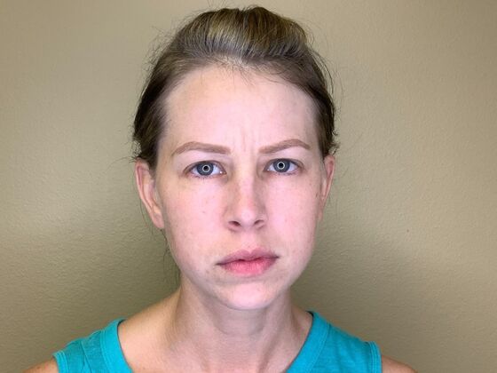 Botox® Cosmetic: Case 9 - Before