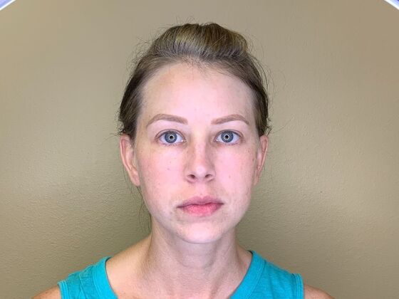 Botox® Cosmetic: Case 9 - Before