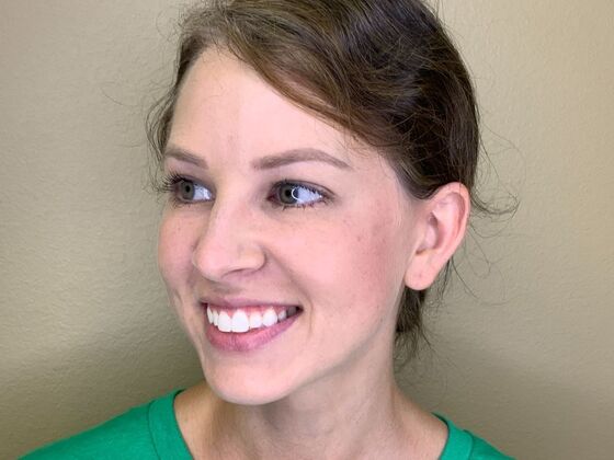 Botox® Cosmetic: Case 9 - After