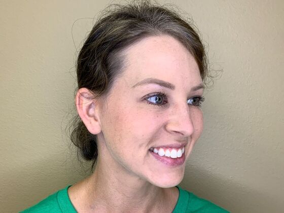 Botox® Cosmetic: Case 9 - After