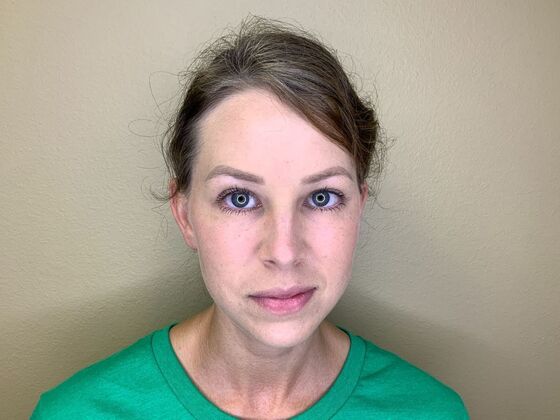 Botox® Cosmetic: Case 9 - After