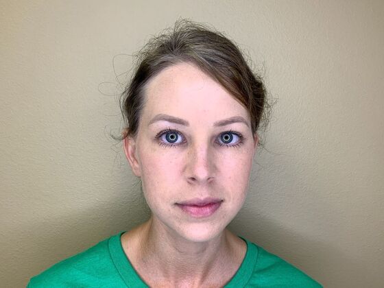 Botox® Cosmetic: Case 9 - After