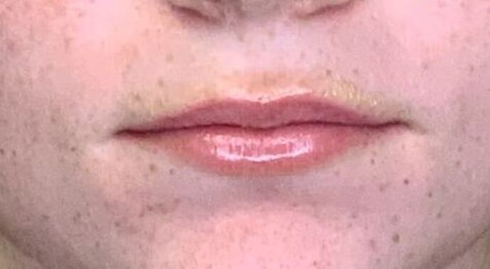 Filler Case 4 - Before