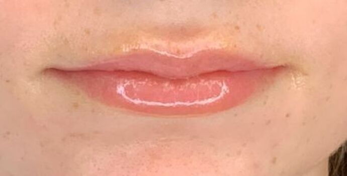 Filler Case 4 - After