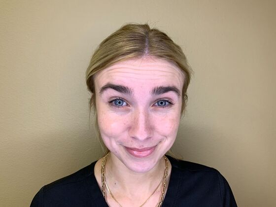 Botox® Cosmetic: Case 10 - After