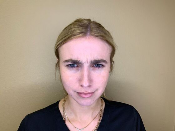 Botox® Cosmetic: Case 10 - After