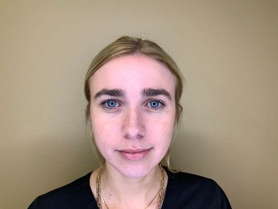 Botox® Cosmetic Case 10 - Before