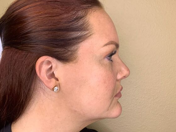 Filler: Case 5 - After