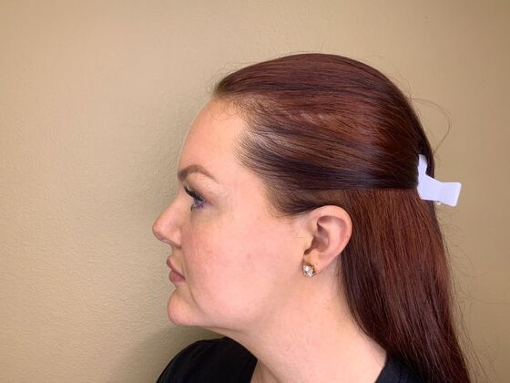 Filler: Case 5 - After