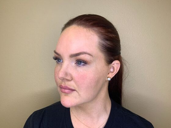 Filler: Case 5 - After