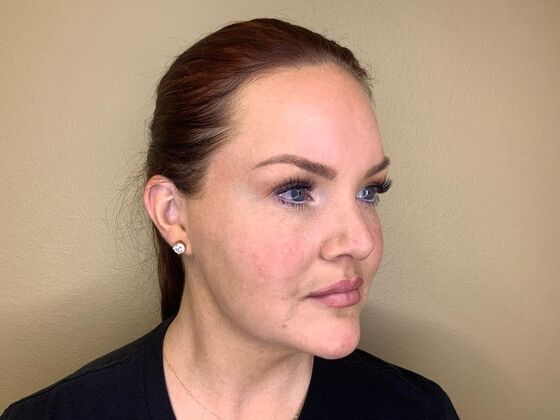 Filler: Case 5 - After