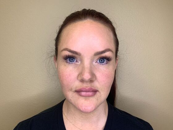 Filler Case 5 - After