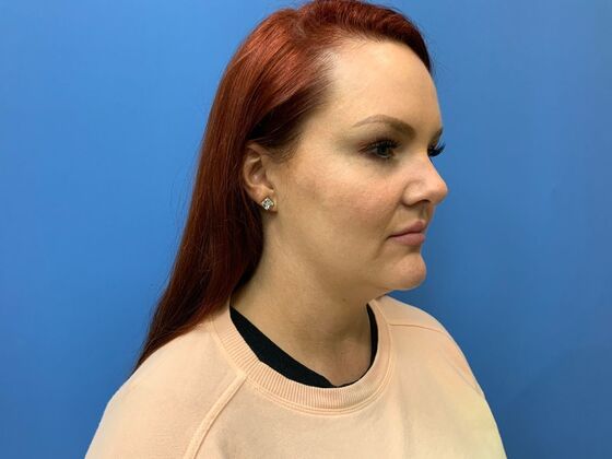 Filler: Case 5 - Before