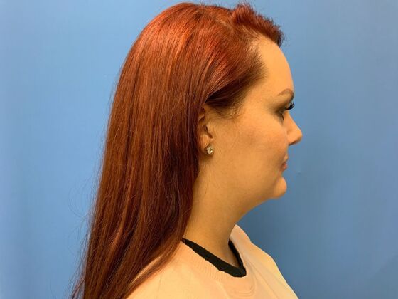 Filler: Case 5 - Before