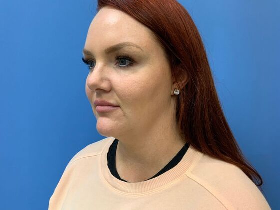 Filler: Case 5 - Before