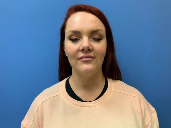 Filler Case 5 - Before