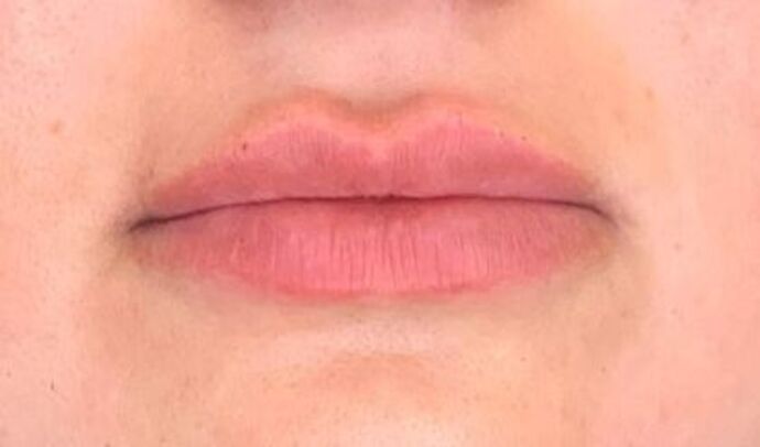 Filler Case 6 - After