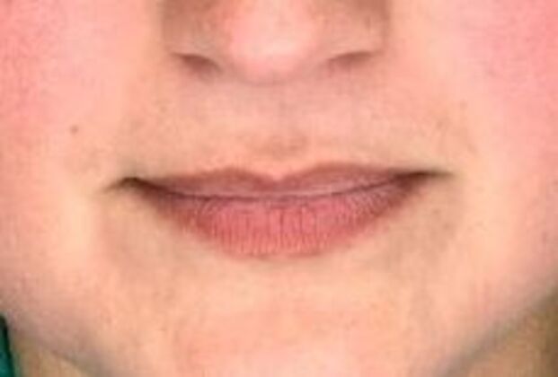 Filler Case 6 - Before