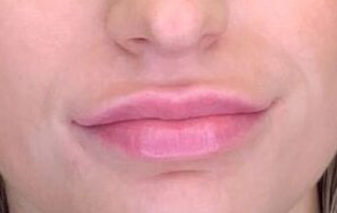 Filler Case 7 - After